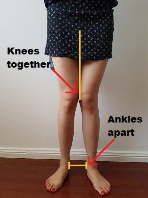 Knock Knees Exercises, Knee Valgus, Flat Feet Exercises, Knock Knees Correction, Genu Valgum, Meniscal Tear, Knock Knees, Hip Problems, Foot Exercises