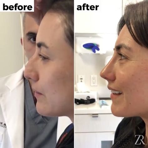 Nonsurgical rhinoplasty is like the magic I never knew existed. Here is my experience with getting a nose job and why you should try it! Nonsurgical Nose Job Before And After, Non Surgical Nose Job Before After, Nose Injections Before And After, Filler Nose Job Before After, Botox Nose Before After, Botched Rhinoplasty, Liquid Nose Job Before And After, Alarplasty Before After, Subtle Nose Job