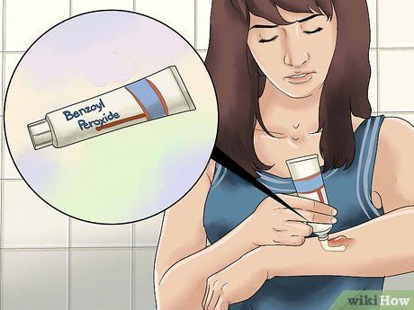 Diy Boil Remedies, Remedies For Boils Groin, Boil Home Remedy How To Get Rid, How To Treat Boils Skin Remedies, How To Treat Boils, Lancing A Boil, Get Rid Of Boils, Home Remedy For Boils, Skin Boil