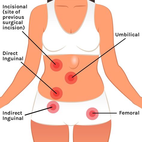 What Is a Hernia? - How To Tell If You Have A Hernia Constipation Remedies, Chronic Constipation, Lymph System, Abdominal Surgery, Nursing School Tips, Lower Abdomen, Diastasis Recti, Med School, Abdominal Muscles