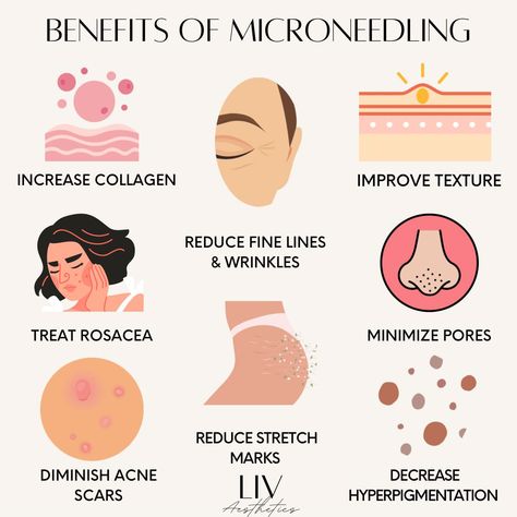 Benefits of microneedling Skin Care Treatments Faces, Skin Care Fun Facts, Microbrasion Facial, Microneedling Marketing, Rf Microneedling Benefits, Med Spa Instagram Post, Micro Needling Benefits, Microneedling After Care, Microneedling Aesthetic