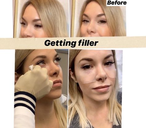 how to look well rested (even if you're not) plus my honest opinion on under-eye fillers | Allyson in Wonderland Under Eye Wrinkles Filler, Eye Trough Filler Before And After, Tear Trough Filler, Eye Filler, Under Eye Fillers, Silk Pillow Case, Tear Trough, Wrinkle Filler, Banana Powder