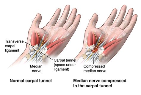 Carpal Tunnel Release | Johns Hopkins Medicine Carpal Tunnel Surgery Recovery, Carpel Tunnel Syndrome, Carpal Tunnel Exercises, Carpal Tunnel Surgery, Carpel Tunnel, Carpal Tunnel Relief, Cervical Disc, Median Nerve, Wrist Pain