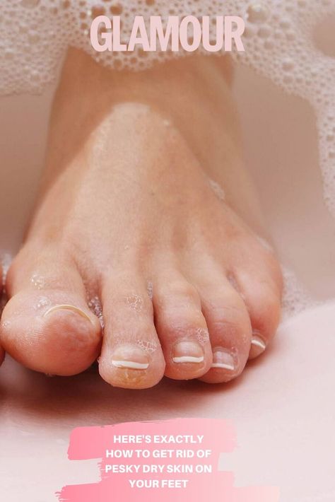 Foot Fungus Remedies, Get Rid Of Dry Skin, Super Dry Skin, Scaly Skin, Extra Dry Skin, Cracked Skin, Rough Skin, Health And Beauty Tips, Kitchen Towel