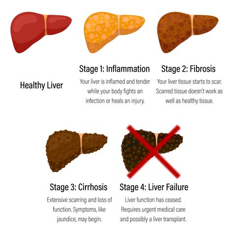 Stages of Liver Failure Liver Fibrosis, Liver Failure, Healthy Liver, The Liver, Medical Care, Healing, Health