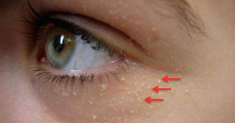 White Bump On Eyelid, White Pimples On Face, White Bumps On Face, Bumps Under Eyes, Moles On Face, Pimples Under The Skin, Pimples Remedies, Pimples On Face, Skin Bumps