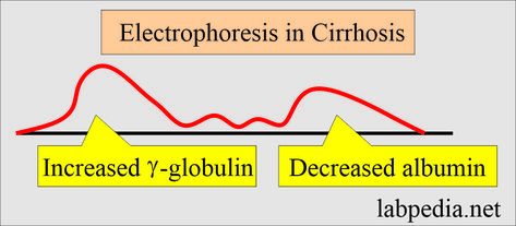 Immunoglobulin Electrophoresis Sample Venous blood is needed to prepare the serum. A random sample can be taken. Purpose of Immunoglobulin Electrophoresis (Indications)  It is advised to diagnose many diseases like Multiple Myeloma etc. Waldenstrom macroglobulinemia. Immunoglobulin electrophoresis is advised if there is a spike in the gamma band in serum electrophoresis. Hypersensitivity reactions. Immune deficiency. Autoimmune diseases. Chronic infections. ... Waldenstrom Macroglobulinemia, Immune Deficiency, Clinical Laboratory, Hypersensitivity Reactions, Nephrotic Syndrome, Medical Dictionary, Severe Burns, Cerebrospinal Fluid, Preventative Health