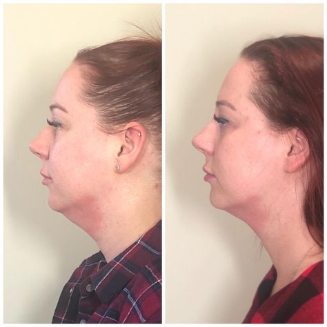 Brilliant results on the chin, give an overall slimmer look. #cryotoning #cryostar #fatfreezing #shapethebodyyouwant #cryofacial #doublechin #chinreduction #cryostarbeauty Double Chin Before And After, Double Chin Reduction, Cryo Facial, Belly Fat Reduction, Fat Freezing, Tighter Skin, Amazing Technology, After Pictures, Loose Skin