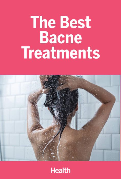 Back Acne Remedies, Lung Cleanse, Back Acne, Bad Acne, Natural Hair Mask, Natural Acne Remedies, Types Of Acne, How To Get Rid Of Pimples, Treat Acne