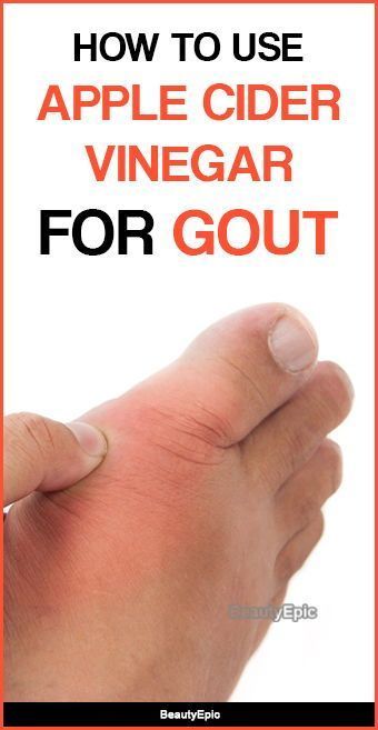 How to use Apple Cider Vinegar for Gout Home Remedy For Cough, Cold Sores Remedies, Natural Sleep Remedies, Uric Acid, Natural Cold Remedies, Cold Home Remedies, Living Healthy, Natural Cough Remedies, Cold Remedies