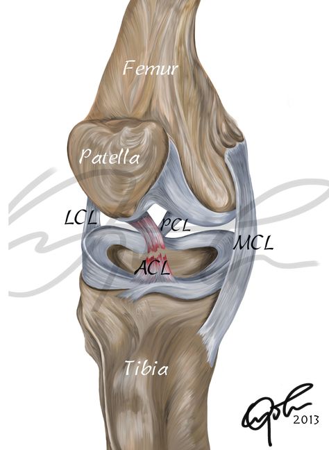 This digital painting depicts the anatomy of a torn ACL (Anterior Cruciate Ligament) This is a digital printable download that you can use in presentations, written editorials etc. You can also frame it up and use to beautify your office or living space should you be so inclined.  Oh and one more thing...  Please note that although the display image has a signature watermark for protective purposes, the actual download is signature watermark FREE. Thanks for stopping by!