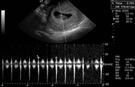 8 Week Ultrasound, Fake Ultrasound, 2 Weeks Pregnant, Ultrasound Gender, Baby Ultrasound Pictures, Baby Heart Rate, Pregnancy Ultrasound, First Ultrasound, Baby Ultrasound