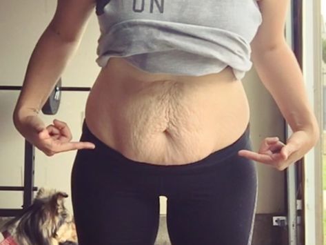 17 Women Share Pics of Loose Skin After Weight Loss to Prove How Common and Normal It Is | SELF Loose Belly, Skin Tightening Face, Tighten Loose Skin, Extra Skin, Excess Skin, Saggy Skin, Loose Skin, Sagging Skin, Skin Tightening