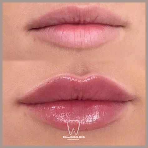 Lip Injections Natural Look, Lip Filler For Hydration, Lip Fuller Shapes, Light Lip Injections, Simple Lip Fillers, Different Types Of Lip Fillers, Before And After Lip Fillers Small Lips, Lip Blush Natural, Top Lip Bigger Than Bottom Lip