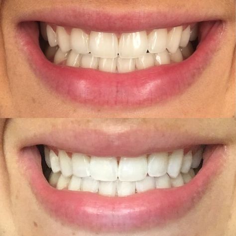 Teeth Whitening Before And After, Clean White Teeth Aesthetic, Instant White Teeth, Straight White Teeth Affirmations, His Smile Teeth Whitening, Toothache Relief, Teeth Whitening Led, Crest Teeth Whitening Light, Best Teeth Whitening Kit