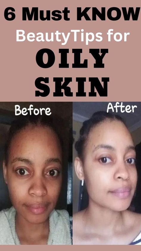 6 Must Know Beauty Tips for Oily Skin: Pollution and dirt can even lead to comedones (skin-bumps) for those with very oily skin. The solution for this is to keep the oil production in control by following some simple beauty and skin care tips for oily skin. These are the 6 tips for facial for oily skin. #Beauty #BeautyTips #OilySkin #SkinCaretips. Beauty Tips For Oily Skin, Facial For Oily Skin, Skincare Supplements, Skincare For Oily Skin, Beauty And Skin Care, Tips For Oily Skin, Skin Bumps, Oil Production, Beauty Guide