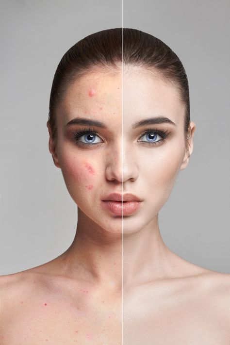 Before And After Acne, Acne Women, Acanthosis Nigricans, Forehead Acne, Pimples Under The Skin, Acne Overnight, Acne Facial, Petroleum Jelly, How To Get Rid Of Pimples