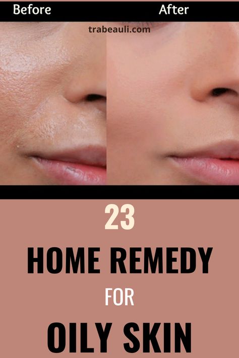 Oily skin people keep removing oil from their face, doing it many times damages the skin cells and skin texture. It is necessary to keep the skin texture and the skin tone balanced and good. So, check out these remedies and share your experience with us in the comment section. Check out the blog- #oilyskin #fairnesstips #homeremedy #skin #beautyskin #healthyskin How To Remove Oil From Face, Improve Skin Texture Naturally, How To Remove Oily Skin, Detan Face Pack At Home For Oily Skin, How To Get Even Skin Tone On Face, Remove Oil From Face, Textured Skin Remedies, Oily Face Remedy, Face Mask For Oily Skin