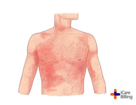 Typhoid fever and paratyphoid fever cause similar symptoms. People with these diseases usually have a fever that can be as high as 103 to 104°F. They also may have weakness, stomach pain, and loss of appetite etc. Some people have a rash of flat, rose-colored spots. Looking for expert #medicalbillers, visit icarebilling.com Loss Of Appetite, Stomach Pain, Some People, Disease, Open Shoulder Tops, Women's Top, Quick Saves, Color