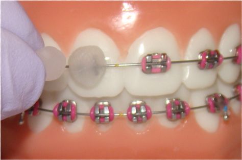 Compraste cera una y otra vez para cubrir tu pobre boca del estúpido y violento metal. Si hiciste aunque sea 10 de estas 24 cosas, sin duda usaste brackets Black Braces Teeth, Palate Expander, Braces Colours, Double Jaw Surgery, Dental Ideas, Braces Pain, Braces Cost, Teeth Aesthetic, Cute Braces Colors