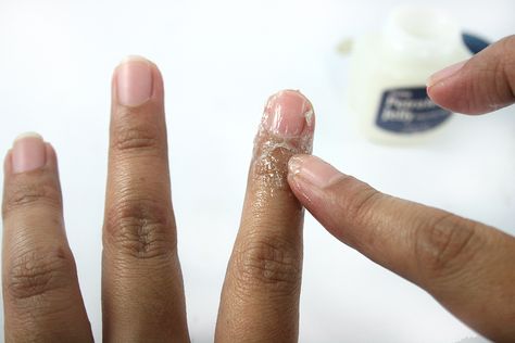 Unfortunately even today, when skin picking is recognized as an official disorder by the mental health manual (DSM-5), the number of professionals who have experience in treating it is very small, compared to the number of people who need help. Around Nails, Nail Care Tips, Cracked Skin, Peeling Skin, Top Nail, Homemade Beauty Products, The Skin, Diy Beauty, Diy Nails