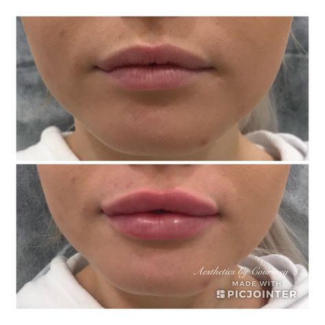 #lips #lipsbycourt #courtcreates #dermalfiller #dermalfillerlips #aesthetics #beautification  #enhance #pout #kiss #results #lipaugmentation #cosmeticinjectables #nurse #injector #cosmetics #lcaparramatta #lcapenrith #lipstolove #aestheticsbycourtney #sydney #sydneylips #mylca Pillow Lips Filler, Pillow Lips, Excessive Underarm Sweating, Botox Lips, Nurse Injector, Cosmetic Injectables, Lip Augmentation, Lip Filler, Lip Enhancement