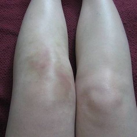 Fluid On The Knee, Diseases Pictures, Swollen Knee, Natural Lubricant, Parasite Cleanse, Disease Symptoms, Knee Pain Relief, Knee Pain, Health Problems