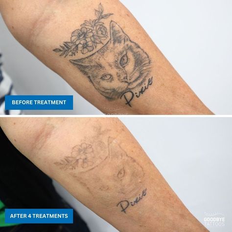 Progress update on our lovely client’s tattoo removal journey after only 4 treatments! Initially, this lovely client planned to remove the entire piece, but during her most recent session, she chose to keep the word "Pixie". Laser tattoo removal is a highly individual process. For some, it’s about starting fresh, while for others, it’s about adjusting or reshaping their story. With only 4 treatments so far, you can see how effective the laser has been in gradually fading her tattoo. He... Her Tattoo, Starting Fresh, Laser Tattoo, Laser Tattoo Removal, Tattoo Removal, Change Of Heart, S Tattoo, Cat Tattoo, Tattoos