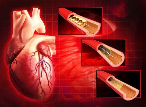 Angioplasty and stents have been found to have no advantage over medication and lifestyle changes for most people with stable heart disease. Heart Stent, Normal Heart, Disease Symptoms, Heart Muscle, Coronary Arteries, Heart Problems, Times Of India, Heart Health, Lifestyle Changes