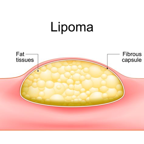 Lipoma Removal, Health Chart, Health Blogger, Toning Workouts, Food Facts, Alternative Health, Natural Home Remedies, Natural Treatments, Healthy Mind