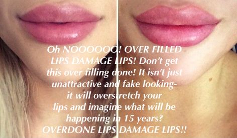 This may be popular BUT overfilled lips damage the lip tissues! In 15 yr when this is out of vogue, floppy, damaged lip tissue will remain. Enjoy filler but don’t do “balloon lips” it isn’t natural and actually is damaging. #dermalfillers #toomuch #choosewisely #dermalfillerspueblo #dermalfillertips Overfilled Lips, Under Eye Hollows, Restylane Lyft, Hyaluronic Acid Fillers, Tear Trough, Instant Face Lift, Injectables Fillers, Lip Filler, Natural Facial