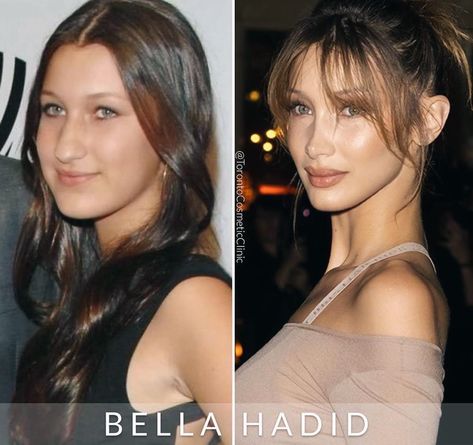 Bella Hadid Before and After Before After Plastic Surgery Faces, Ponytail Lift Surgery, Alarplasty Before After, Plastic Surgery Celebrities, Bella Hadid Nose, Plastic Surgery Aesthetic, Face Plastic Surgery, Nose Surgery Rhinoplasty, Celebrity Surgery