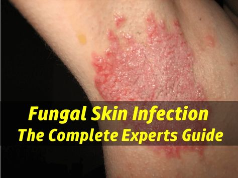 Skin Fungus Experts Guide: learn how to identify the causes & types of skin fungal infections, proper way to treat, and common critical mistakes to avoid. Yeast Infection On Skin, Fungal Rash, Rash Causes, Skin Symptoms, Skin Fungus, Fungal Infection Skin, Yeast Infection Symptoms, Skin Remedies, Yeast