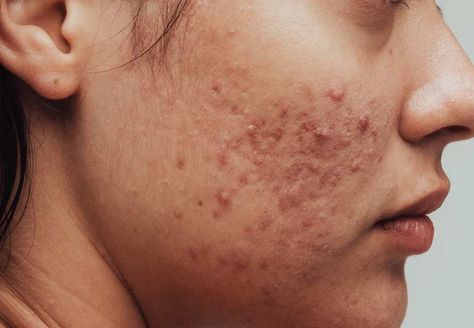 Cheek Breakouts, Postpartum Acne, Jawline Acne, Mouth Wrinkles, Face Mapping Acne, Blind Pimple, Pimples Under The Skin, Pimples Overnight, Pimples On Face