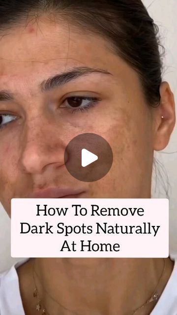 Face Darkness Removal, How To Treat Dark Neck, Home Remedies For Dark Spots, How To Remove Black Dots On Face, Face Black Spot Removal, How To Fade Dark Spots On Face, Dark Area Around Mouth, Best Dark Spot Remover For Face, How To Remove Dark Spots