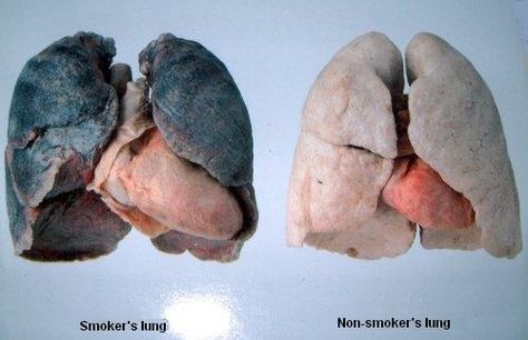 Smokers Lungs and Heart on left - Healthy on right... you choose. Lung Detox, Healthy Lungs, Lungs Health, Natural Home Remedies, Health Info, Lungs, Natural Medicine, Health Remedies, Body Health