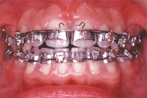 Fully banded orthodontic braces used in the 1960s-1970s and early 1960s. Every tooth was wrapped with a steel and te bracket attached to the band. The bands require room between every tooth so rubber spacers were force between each tooth to create the gap. In a few days the teeth moved apart but it was very painful. Fitting the bands and other gear was a long process, usually at least two four hour appointment were required. Braces Problems, Disney Gel Nails, Plastic Bibs, Adult Braces, Female Dentist, Orthodontic Appliances, Braces Girls, Brace Face, Orthodontics Braces