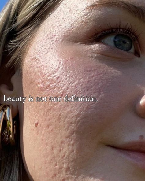 Acne Positivity Quotes, Acne Is Beautiful, Imperfect Bodies, Imperfect Skin, Girl With Acne, Face Imperfections, Acne Positivity, Skin Positivity, Change Myself