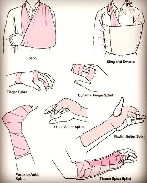 Medical Doctors Worldwide on Instagram: “The Sling & Swathe Method is a technique designed to stabilize the arm in cases of a shoulder dislocation, subluxation or fracture.” Bandage Arm Aesthetic, Doctor Pose Reference, Shoulder Dislocation, First Aid Tips, Bone Fracture, Medical Procedures, Medical School Studying, Survival Life Hacks, Survival Techniques