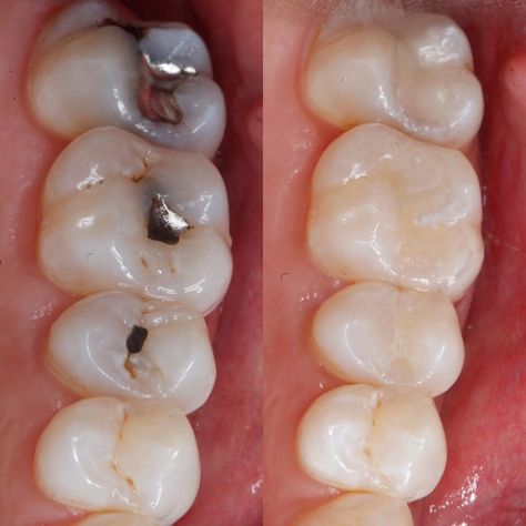 Teeth Composite, Dentist Career, Dental Content, Composite Fillings, Dental Composite, Dental Images, Tooth Filling, Dental Fillings, Dental Veneers