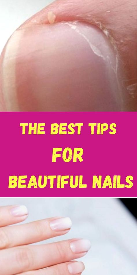 Split Nail Repair, Nail Remedies, Split Nails, Cracked Nails, Weak Nails, Nail Repair, Nail Care Tips, Brittle Nails, Nail Art Designs Diy