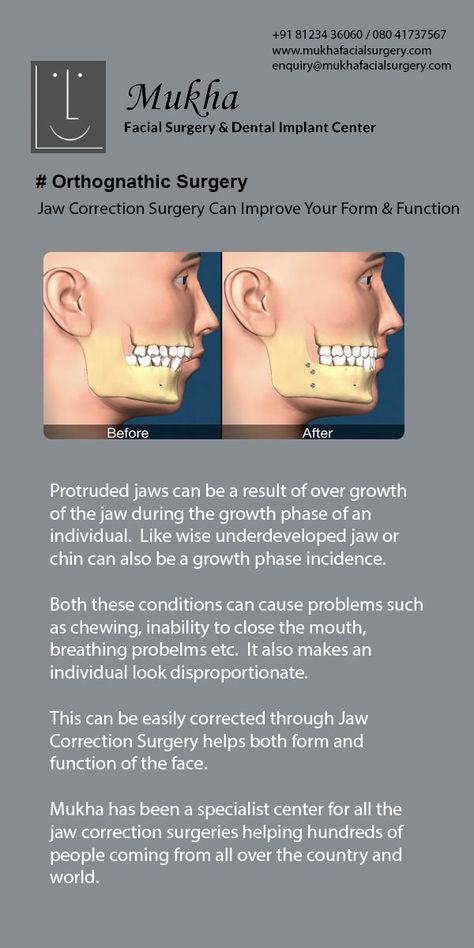 Corrective Jaw Surgery, Mouth Breathing, Orthognathic Surgery, Types Of Humans, Jaw Surgery, Facial Surgery, Clear Healthy Skin, Tooth Extraction, Dental Implant