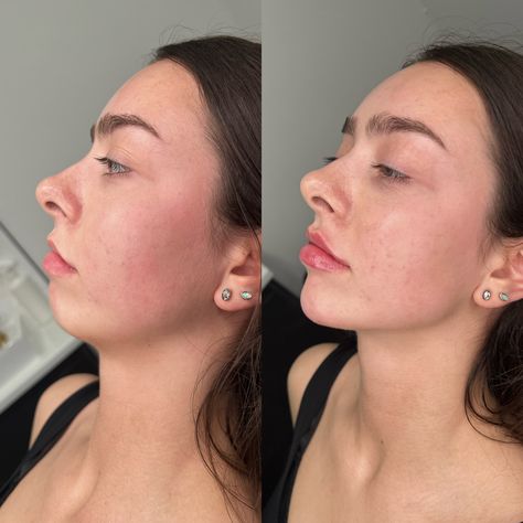 Chin, Lip & Jawline Filler. ✨💉 Lip Filler Contour, Chin Jaw Filler, Lip Filler Bow Shape, Botox Cheeks Before After, Chin And Lip Filler, Cheek And Chin Fillers Before After, Before And After Jaw Filler, Chin And Jawline Fillers, Jaw Contouring Filler