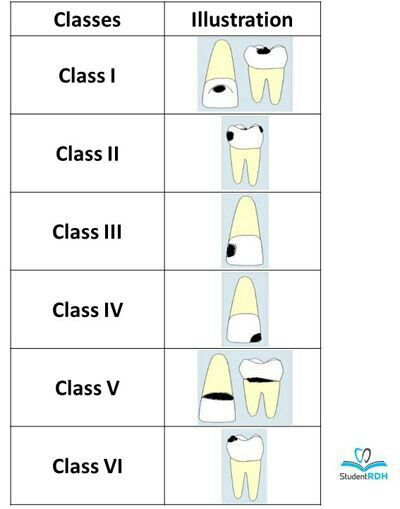 Gv Black Caries Classification, Dental Charting Symbols, Pediatric Dental Assistant, Dental Assistant Study Guide, Dental Charting, Dental Nursing, Dental Assistant School, Dental Hygienist School, Hygiene School