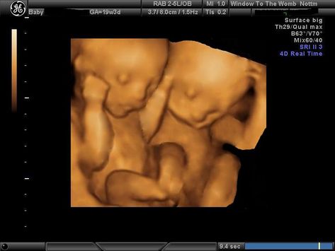 Twins Ultrasound, 3d Ultrasound, Luxury Kids Bedroom, 20 Weeks Pregnant, Twin Baby Boys, Baby Ultrasound, Ultrasound Tech, Twin Baby Girls, Best Poses For Pictures