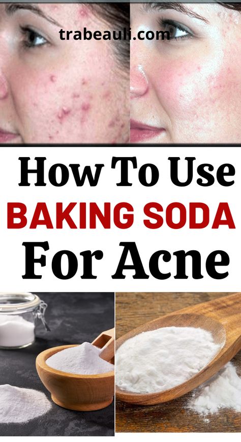 baking soda for acne Baking Soda Face Mask For Acne, Baking Soda Face Scrub Acne, Diy Zit Remover Overnight, Overnight Acne Remedies Fast, Bicarbonate Of Soda Uses, Baking Soda For Skin, Baking Soda For Acne, Baking Soda Coconut Oil, Baking Soda Face