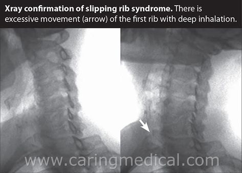 Slipping Rib Syndrome, Thoracic Cage, First Rib, Referred Pain, Upper Back Pain, X Rays, Heart And Lungs, Intensive Care Unit, Chest Pain