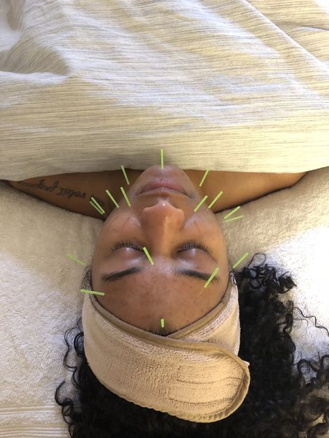 Acupuncture For Acne | POPSUGAR Fitness Comedonal Acne, Back Acne Remedies, Acupuncture Clinic, Forehead Acne, Natural Acne Remedies, Popsugar Fitness, Health Trends, Acne Remedies, Acupressure