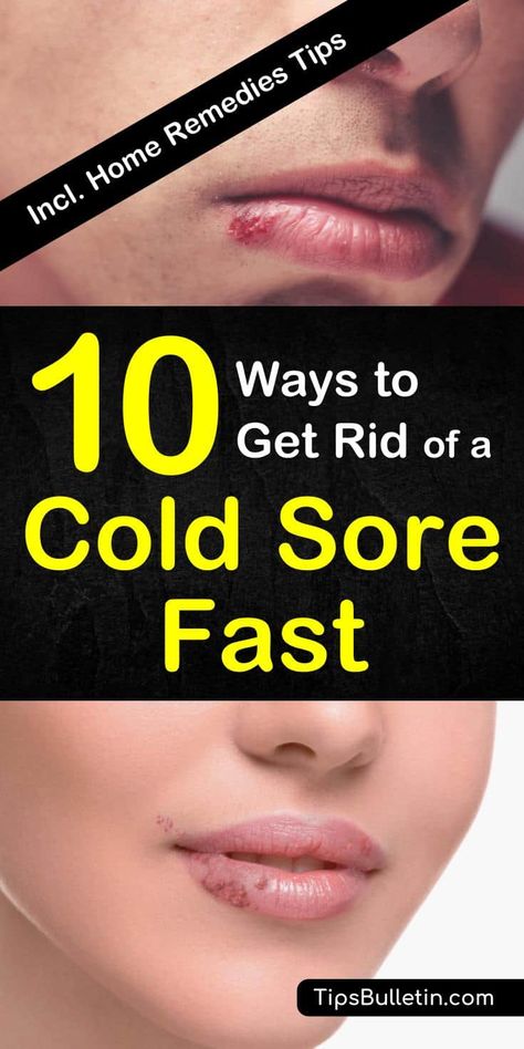 10 Ways To Get Rid Of A Cold Sore Fast Get Rid Of Cold, Fever Blister, Canker Sore, Cold Symptoms, Cold Sores Remedies, Natural Antibiotics, Cold Sore, Cold Remedies, Simple Home