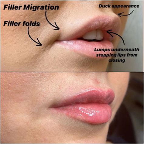 Lip Filler Dissolved Before And After, Madelyn Cline Lip Fillers, 1ml Lip Filler Small Lips, Bad Lip Filler, Lip Filler On Small Lips, Round Lips Filler, Migrated Lip Filler, Natural Lip Fillers, Lip Fillers Before And After 1ml